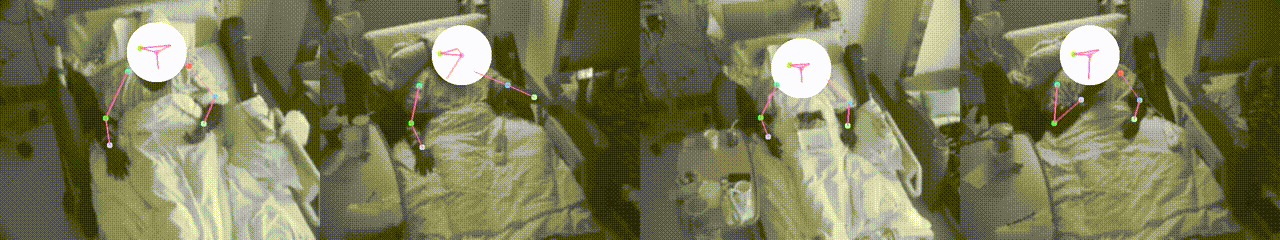 Pose tracking of a patient's wrist movements in long-term hospital video, from the J. Neuroscience Methods paper